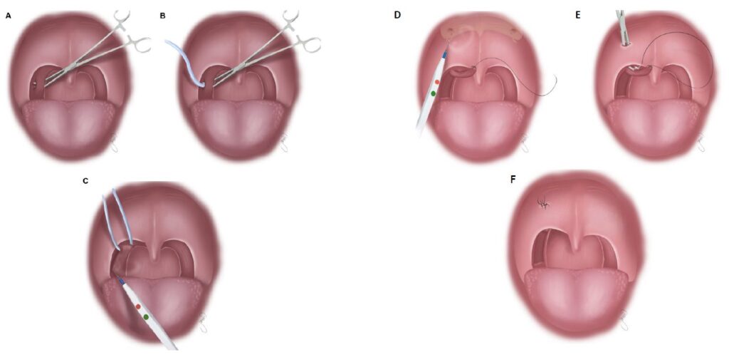 θεραπεια ροχαλητου απνοιας
 Χειρουργική Τεχνική Expansion Sphincter Pharyngoplasty 
